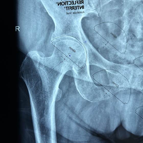 Caso real de artroplastia de cadera 04