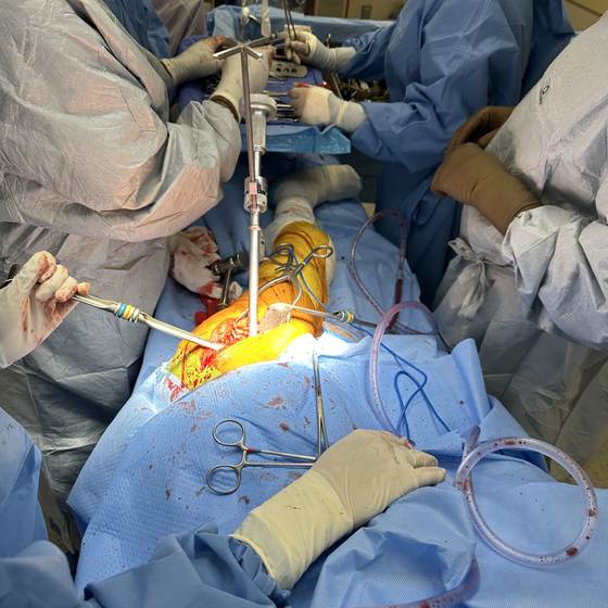 Caso real de artroplastia de cadera 10