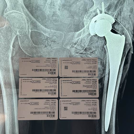 Caso real de artroplastia de cadera 21