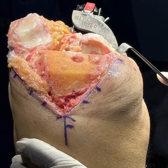 Caso real de artroplastia de rodilla 04