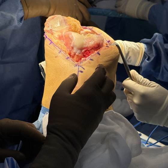 Caso real de artroplastia de rodilla 08