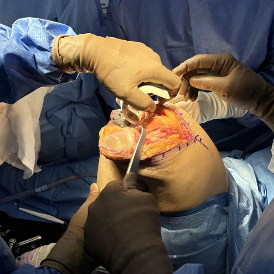 Caso real de artroplastia de rodilla 12