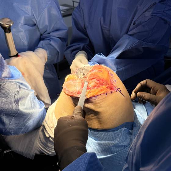 Caso real de artroplastia de rodilla 13