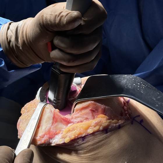 Caso real de artroplastia de rodilla 21